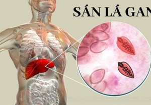 Bệnh Sán Lá Gan: Cập Nhật Kiến Thức Mới Nhất